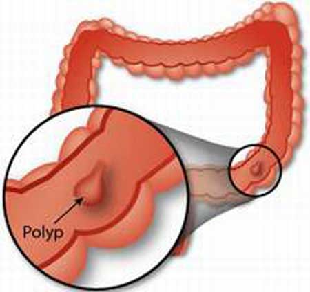 Tìm hiểu bệnh polyp hậu môn