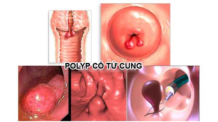 Polyp cổ tử cung có dấu hiệu gì