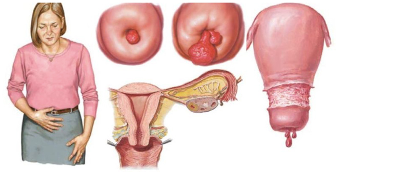 Tìm hiểu về bệnh polyp cổ tử cung