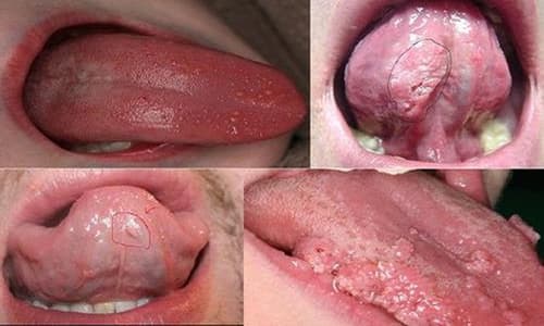Bệnh sùi mào gà ở miệng có triệu chứng và cách chữa trị như nào?