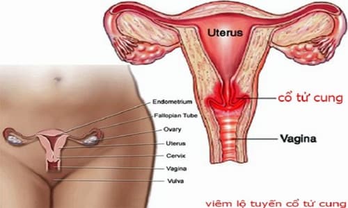 Dấu hiệu viêm lộ tuyến cổ tử cung