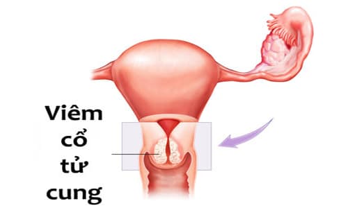 Viêm cổ tử cung nhẹ: Nguyên nhân , dấu hiệu và cách điều trị
