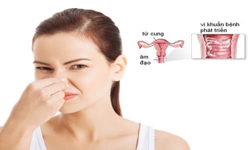 Bộ phận sinh dục nữ có mùi hôi: Nguyên nhân và cách điều trị