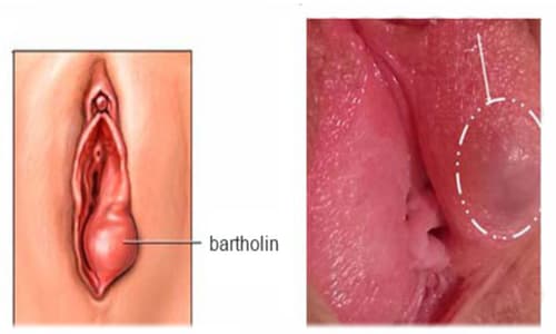 Viêm tuyến bartholin: Nguyên nhân, dấu hiệu và cách chữa viêm tuyến bartholin