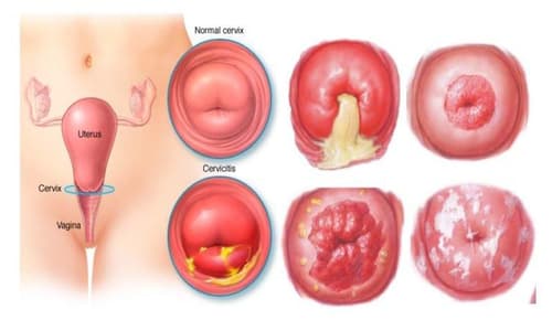 Viêm cổ tử cung: Nguyên nhân, dấu hiệu nhận biết và cách chữa trị